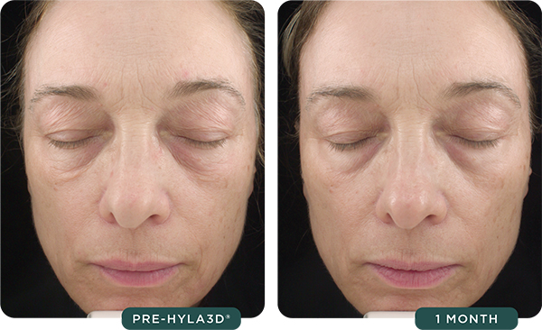 Hyla3D® Face Serum