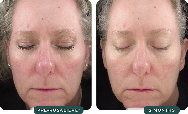 RosaLieve® Redness Reducing Complex